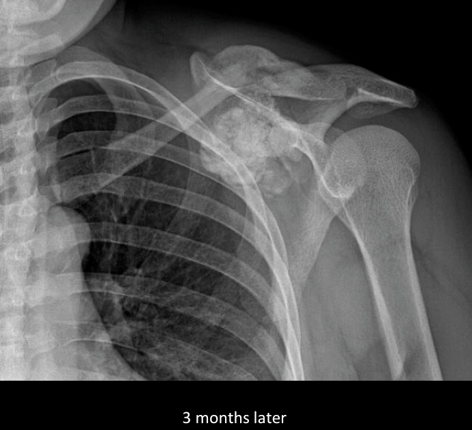 Figure 2 for case Presumed brown tumor and tumoral calcinosis